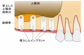 http://www.implant-map.jp/imp8/s-04.jpg