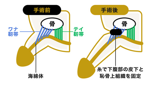 切らない長茎術
