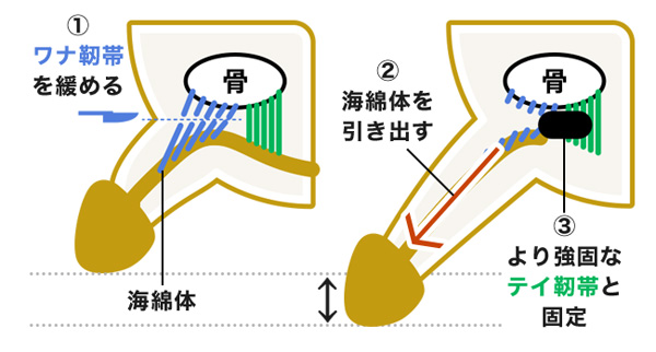 アトムクリニックの切る長茎手術