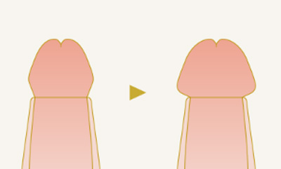 アトムクリニックの亀頭増大術
